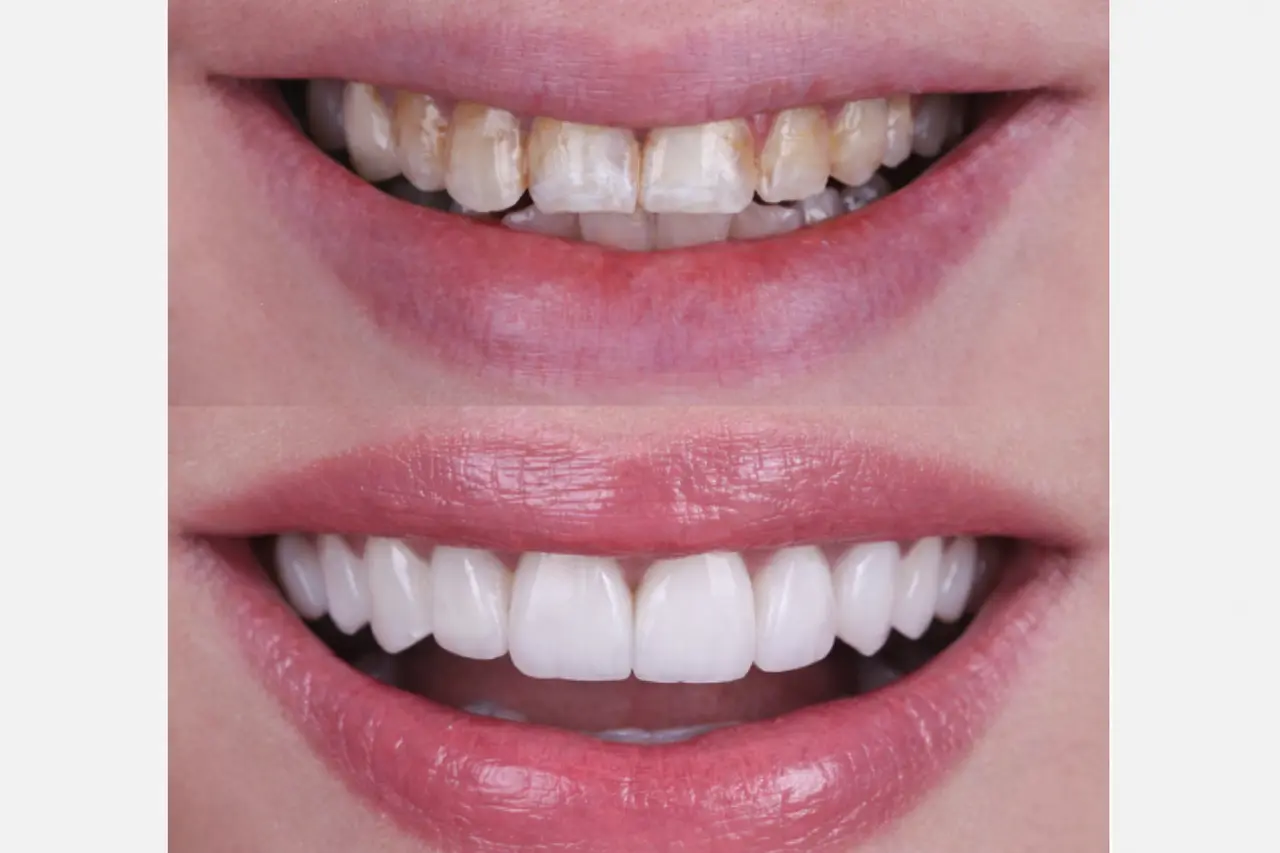 قبل وبعد الحالة 01